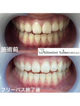 ホワイトニングサロン 京都烏丸店/ホワイトニング施術例