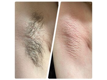 リアンジェ(Lianje)/ワックス後の美肌脱毛がおすすめ