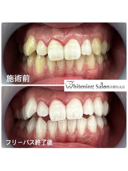 ホワイトニングサロン 京都烏丸店/ホワイトニング施術例