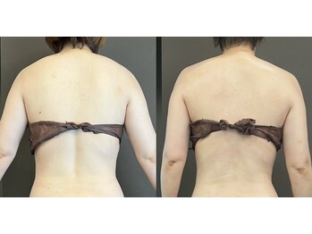 ステラ(Stella)/肩首コリには筋膜リリース！