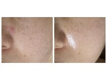 ジャスミン(Jasmine)の雰囲気（リピート率9割以上！シミの排出を促す"炭酸"を使うピーリング！）