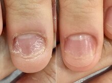 リファーレ(RIFARE)/【深爪矯正】1回で見た目が変化