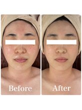 ソアー(Soar)/小顔フェイシャル/ツヤ肌/小顔