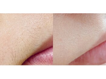 メイクマジック(Makemagic)/お口周りのうぶ毛スッキリ