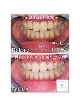 ホワイトニングビューティー 吉祥寺店/症例写真_初来店されたお客様