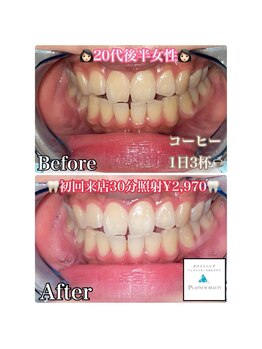 ホワイトニングビューティー 吉祥寺店/症例写真_初来店されたお客様