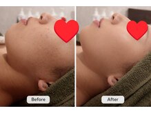 キラベル 平塚店(KiraBelle)/平塚/陶肌12回で肌質改善◎