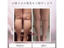 トータルビューティー筋膜ケアサロン カンスタイル(Kanstyle)の雰囲気（筋膜リリース5回）