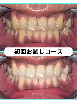 ホワイトニングビューティー 吉祥寺店/ホワイトニング 初来店