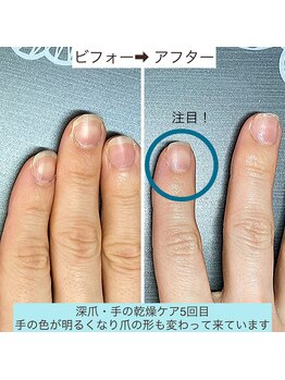 自爪育成は爪の形を変えます