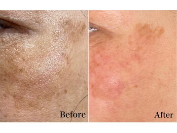 リブ(Lib)/Whiteshine×ハーブピーリング