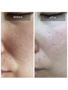 ラ ドウ 名古屋黒川店(la.dow)/ほうれい線改善♪