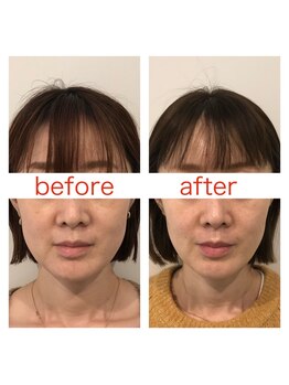 ジョア(joie)/美容鍼で小顔＆美肌