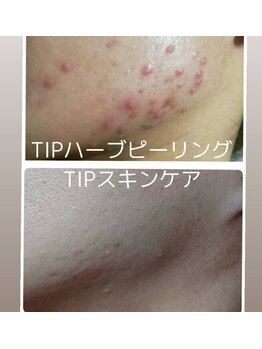 ビーピー 渋谷(b.p.)/ハーブピーリング