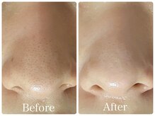 オレンジ(Orange)/【顔全体】毛穴・角質ケア120分