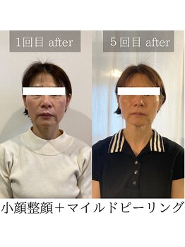 マシェリ(ma cherie)/マイルドピーリングコース５回