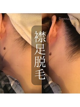 ディオーネ 麻布十番(Dione)/【脱毛】襟足