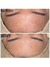 ディオーネ 春日井勝川店(Dione)/顔脱毛＋毛穴洗浄