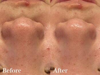 シャルム(Charme)/メンズフェイシャル♪毛穴ケア