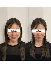 黒田鍼灸治療院/美容鍼の変化例