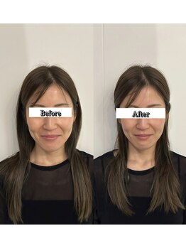 黒田鍼灸治療院/小顔美容鍼フェイスライン