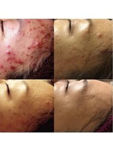 アンジェーム(ANGEAME)/ハーブトリートメント