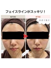 ビーフィール 府中店(be feel)/フェイスラインもスッキリ小顔へ