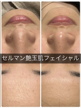 ソラウミ(SORAUMI)/角質ケアしてますか？