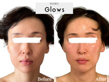 グロウズ(Glows)/中顔面の短縮/ほうれい線も浅く