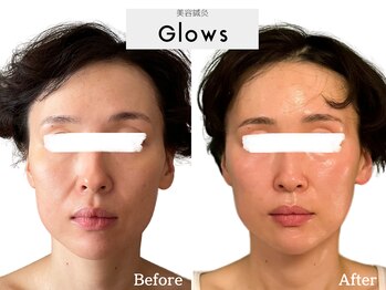 グロウズ(Glows)/中顔面の短縮/ほうれい線も浅く