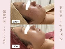 ルア(LuA.)/赤み・跡も改善◎