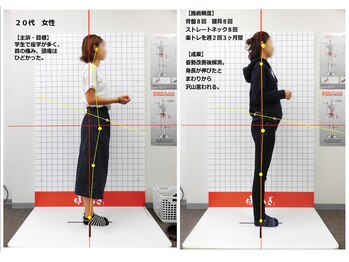 ほねつぎ 府中鍼灸整体院/【症状】 首痛 ストレートネック