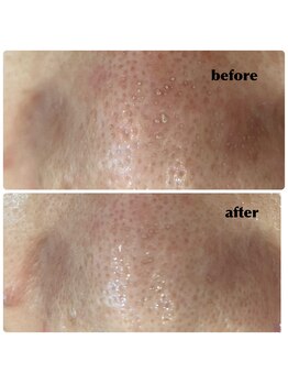 エステティックサロン ベルエトワール住吉店/頑固なブツブツ毛穴お任せ下さい