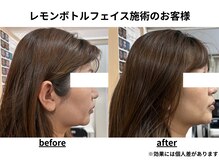 トータルビューティーみつとも/レモンボトル/顔のたるみ/二重顎