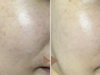 ドゥナ(DUNA)/韓国女優肌ピーリング