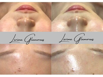 ラリマ グラマラス(Larima Glamorous)/ピーリング×コラーゲンW導入