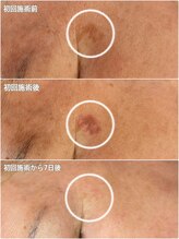 桜/最新光フェイシャル♪ビフォアフ