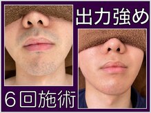 ファシネイト 新宿本店(Fascinate)/ヒゲ脱毛【メンズ脱毛/新宿】