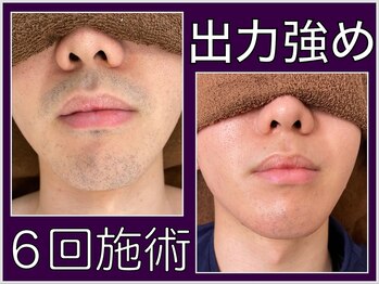 ファシネイト 新宿本店(Fascinate)/ヒゲ脱毛【メンズ脱毛/新宿】