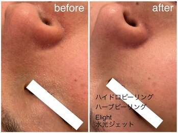 メゾンリュバン 梅田店(Maison Ruban)/毛穴洗浄・ハーブピーリング