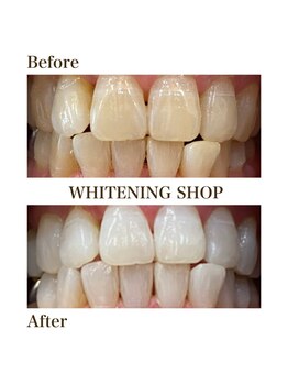 ホワイトニングショップ 元町 中華街店/効果に自信あり♪Before&After