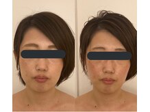 ハイコガオ 中崎町店(HIKOGAO)/小顔矯正60分