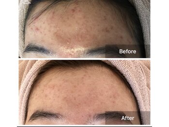 モカ 天王寺店(MOKA)/おでこニキビケア　ハーブ