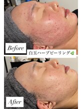 シェリ フルール(Cheri Fleur)/ニキビにテキメン！