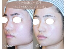 岩川治療院/エラの強張り、肌改善