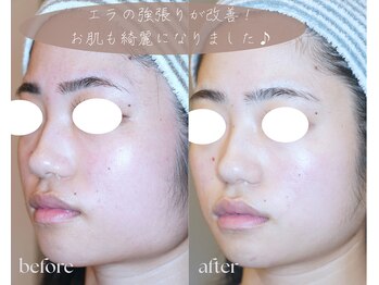 岩川治療院/エラの強張り、肌改善