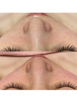 ロカヒ(Lokahi)/ハイドラフェイシャル♪