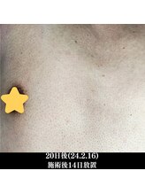 レイ(R.E.I)/【脱毛アフター】胸