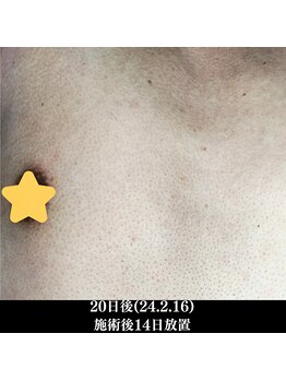 レイ(R.E.I)/【脱毛アフター】胸