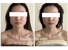 ルルボーテ(Loulou Beaute)/頭蓋骨調整＋小顔矯正